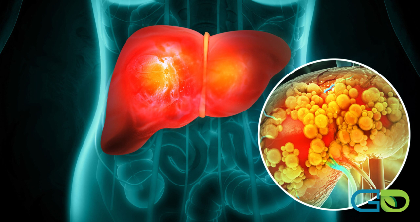 پیشگیری از کبد چرب؛ پاکسازی فوری کبد بدون دارو