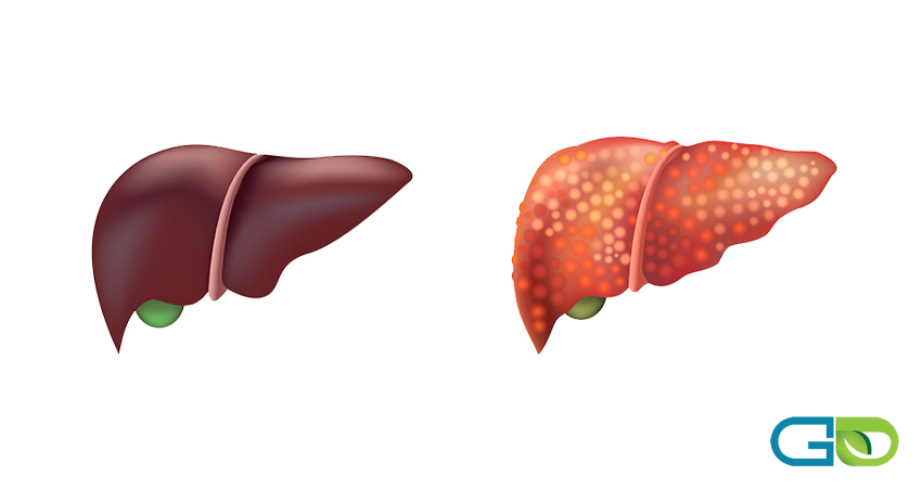 تغذیه سالم؛ بهترین راه پیشگیری از کبد چرب
