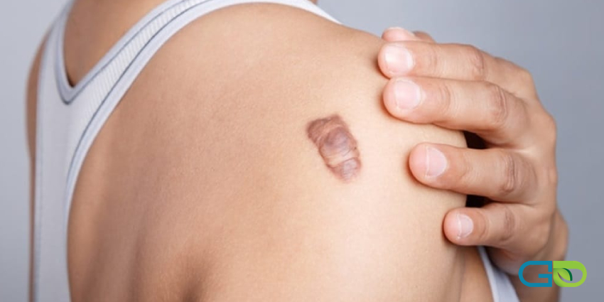 بهترین روشهای درمان گوشتهای اضافی