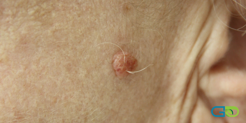 روشهای مراقبتی پس از جلسات درمان گوشت اضافی