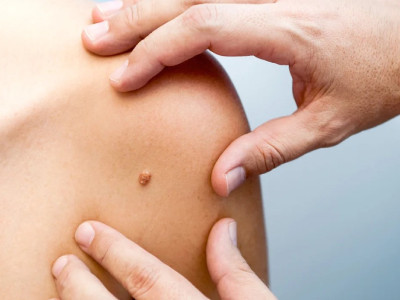 درمان گوشت‌های اضافی برای حذف دائمی اسکار کلوئید