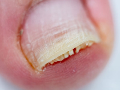 علت جدا شدن ناخن از گوشت یا بستر؛ از دلایل تا درمان اصولی