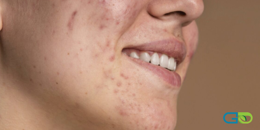 چگونه در تابستان از بروز جوش جلوگیری کنیم؟
