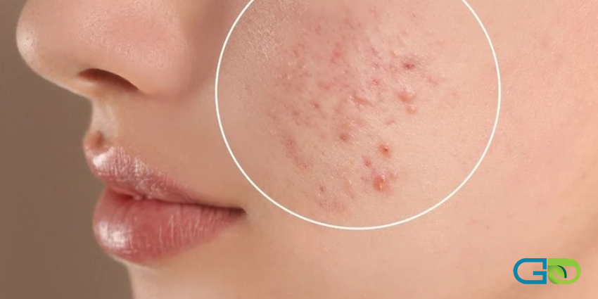 چرا جوش پیشانی در تابستان بیشتر میشود؟